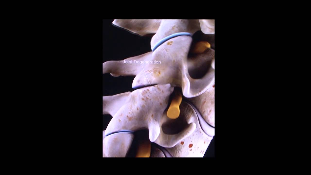 estenosis foraminal bilateral c5 c6 y c6 c7