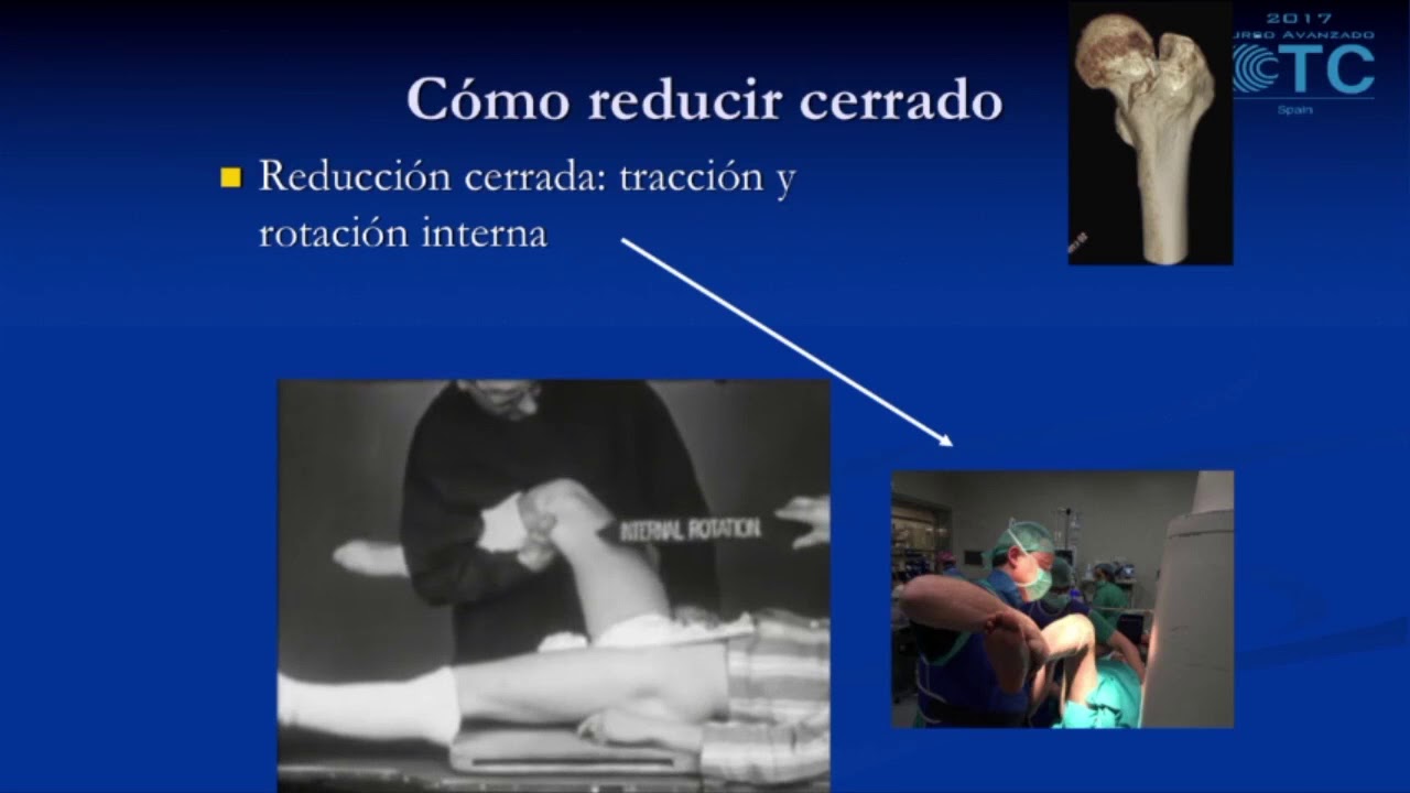 fractura de cadera en personas jovenes