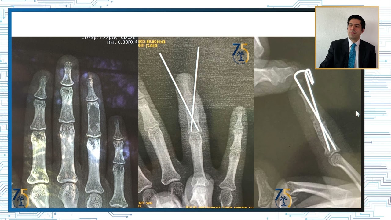 fractura de falange proximal de la mano