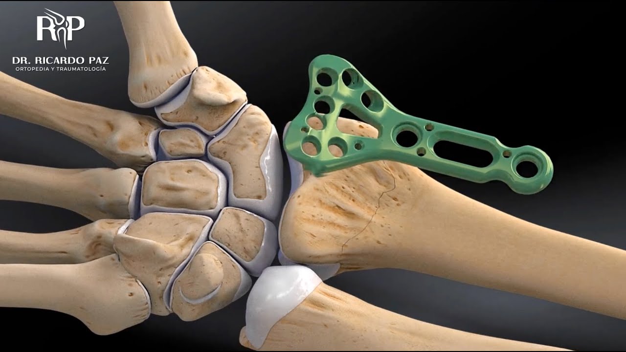 fractura de metafisis distal de radio