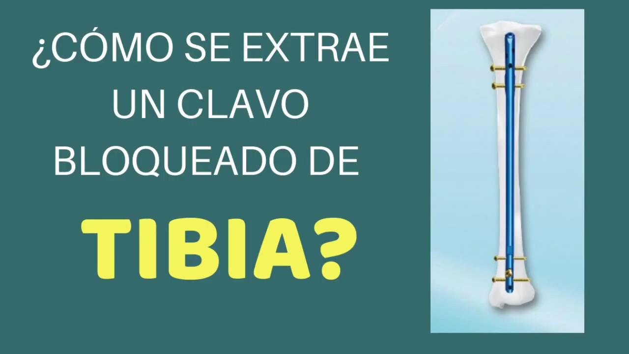 fractura de tibia y perone con clavo intramedular
