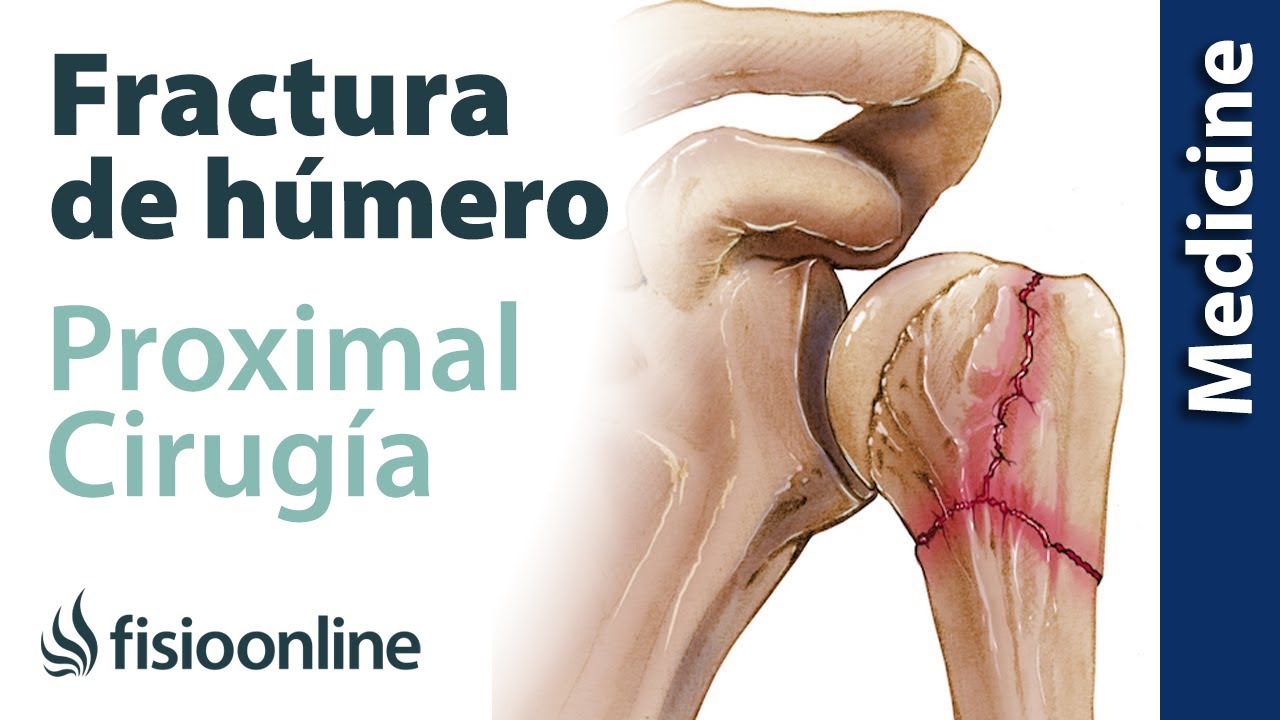 fractura del cuello quirurgico del humero