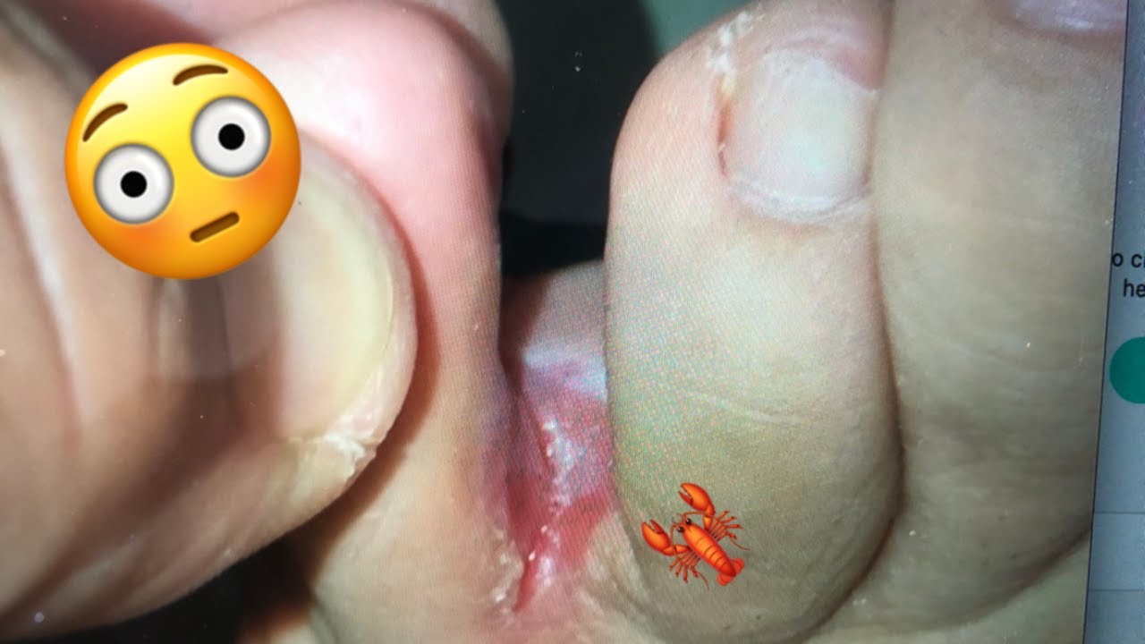 grietas entre los dedos de los pies