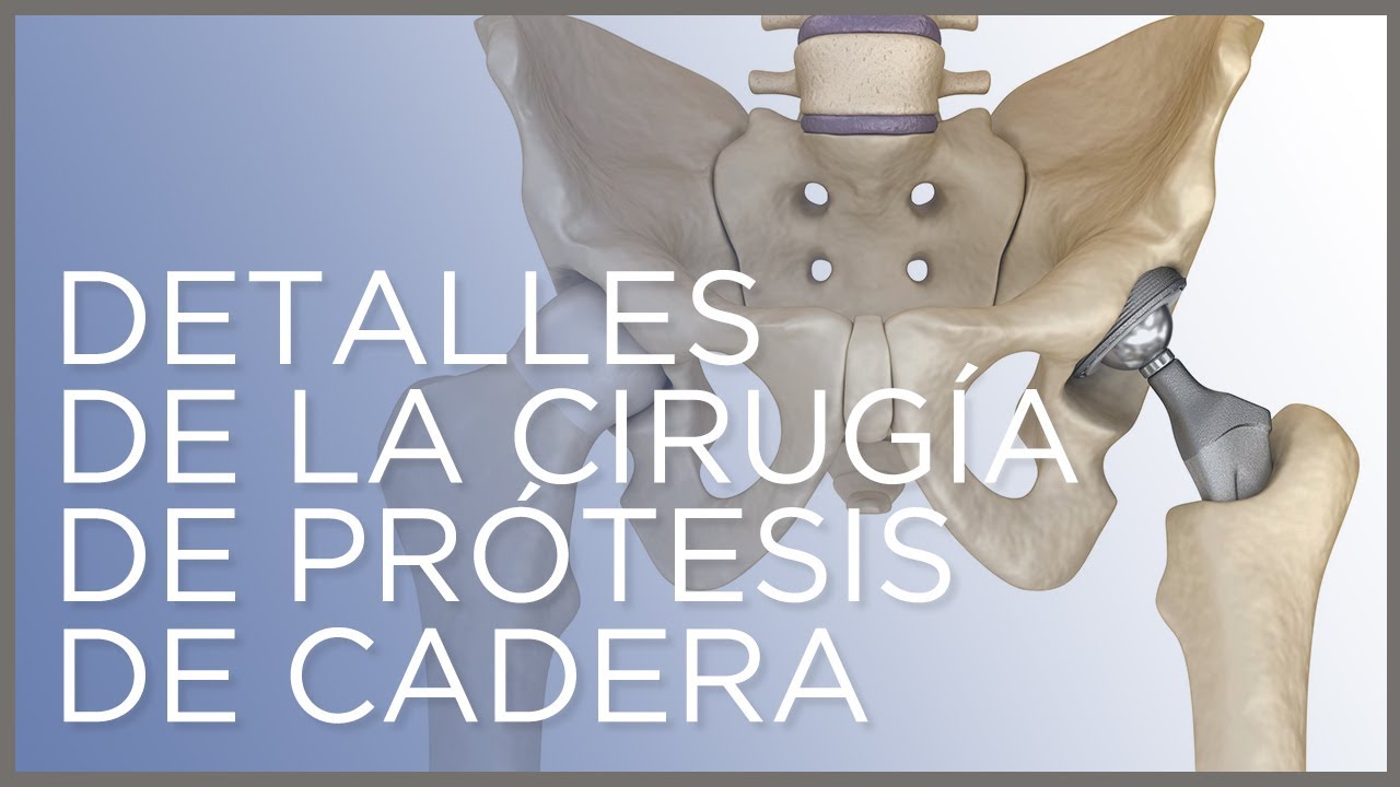 operacion de cadera con clavo recuperacion