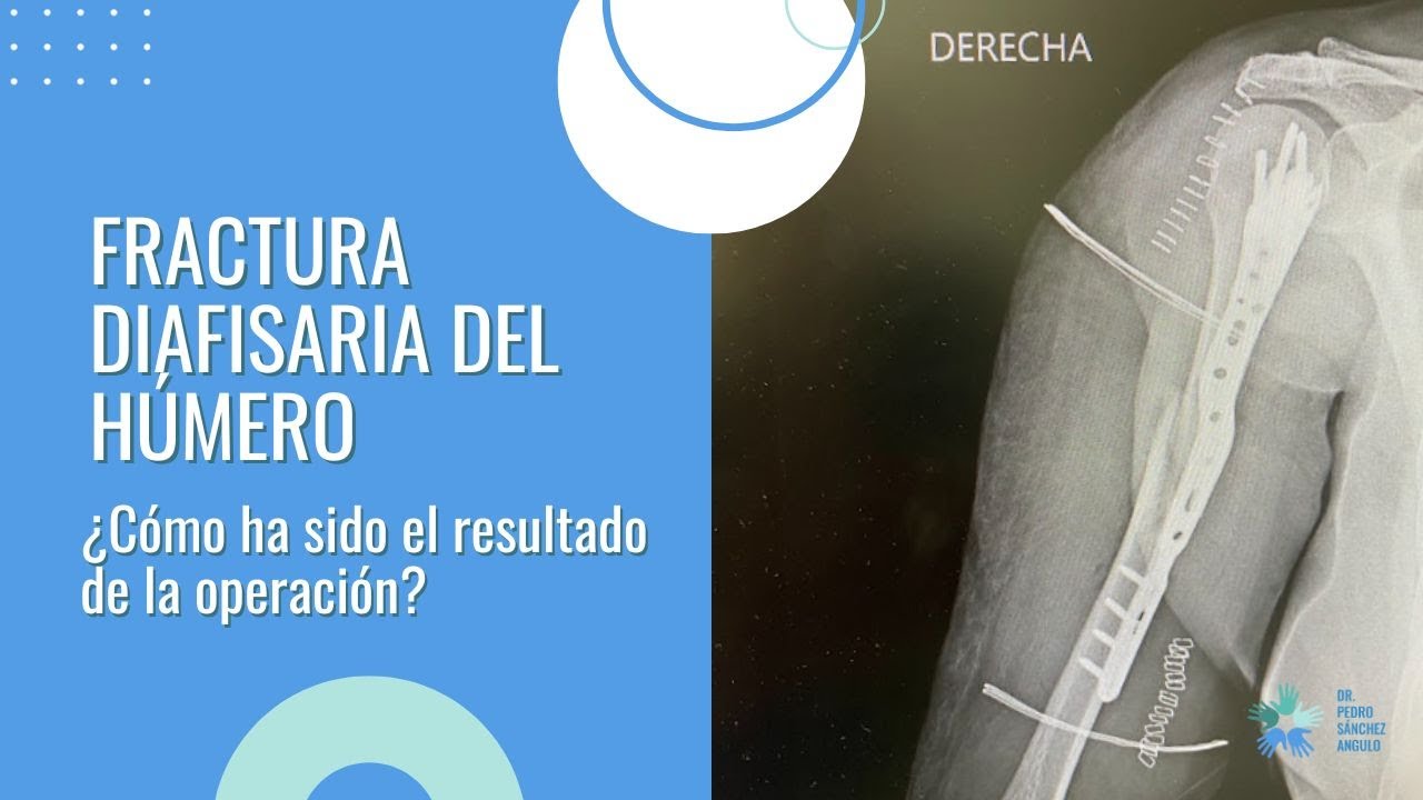 operacion de humero con placa y tornillos recuperacion