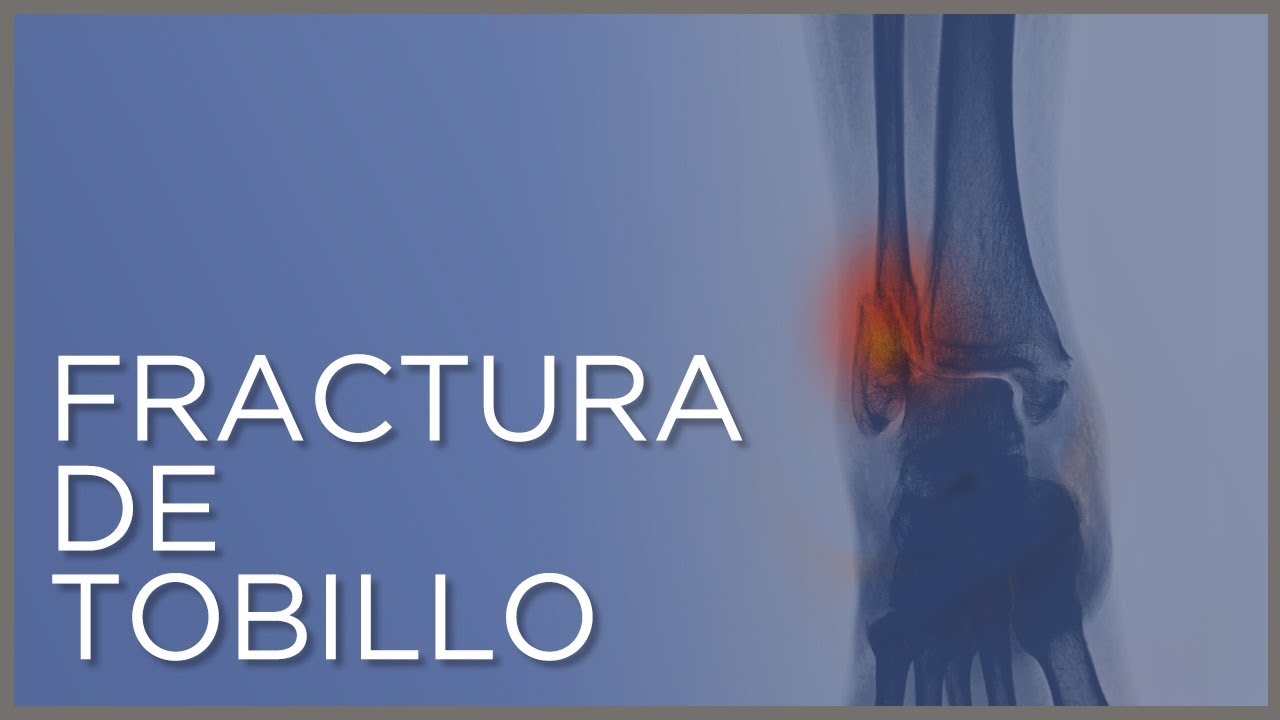operar o no una fractura maleolo