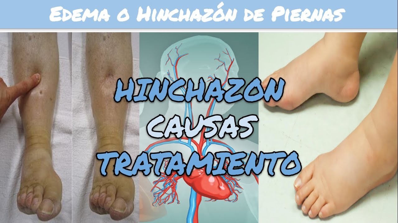porque salen hundimientos en las piernas