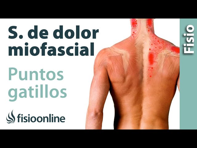 puntos gatillo en el cuerpo humano