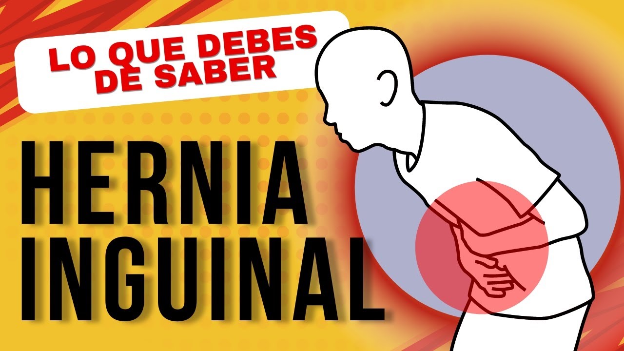 qué diferencia hay entre una hernia inguinal directa e indirecta