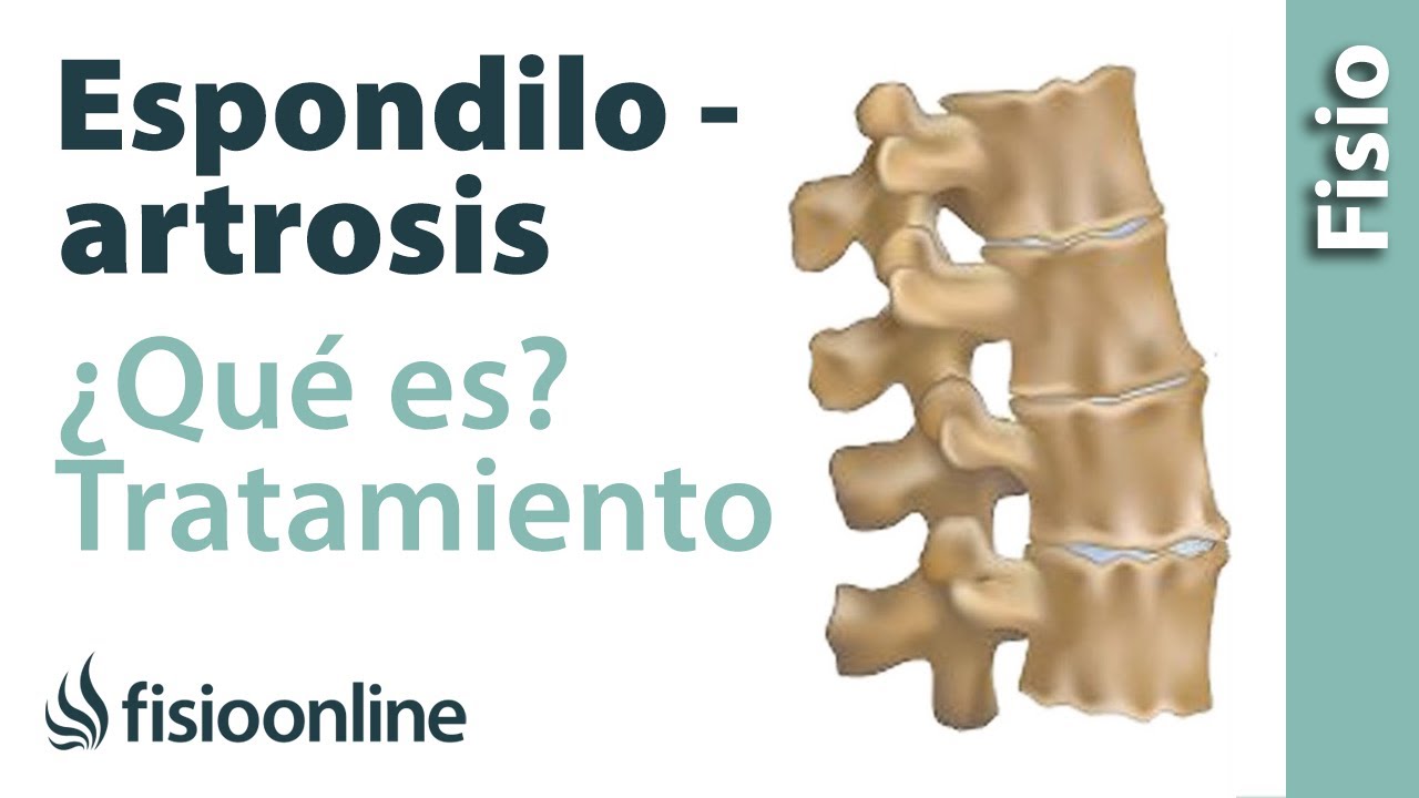 que es espondiloartrosis de columna lumbar