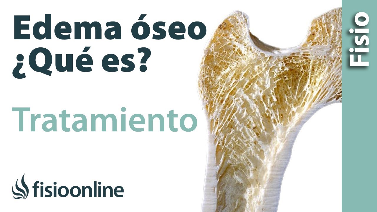 que es un edema oseo de tobillo