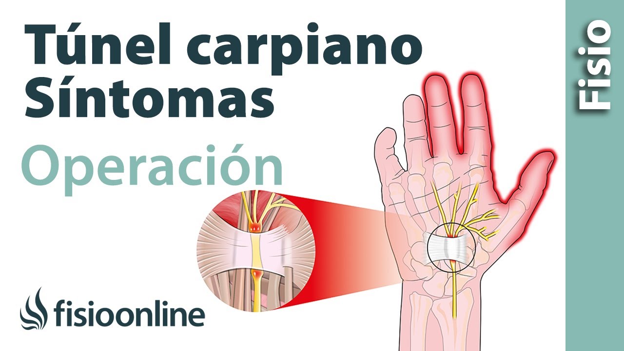 qué riesgos tiene la operacion del túnel carpiano