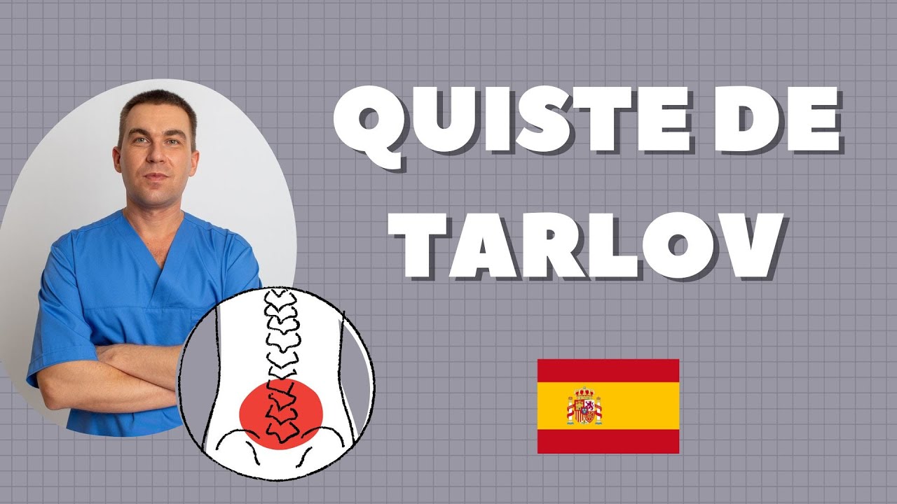 quistes de tarlov en raices lumbares y sacras