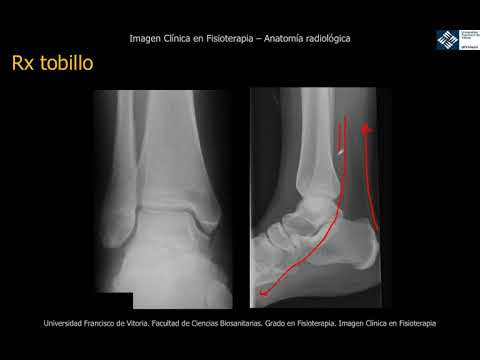 radiografía de un esguince de tobillo
