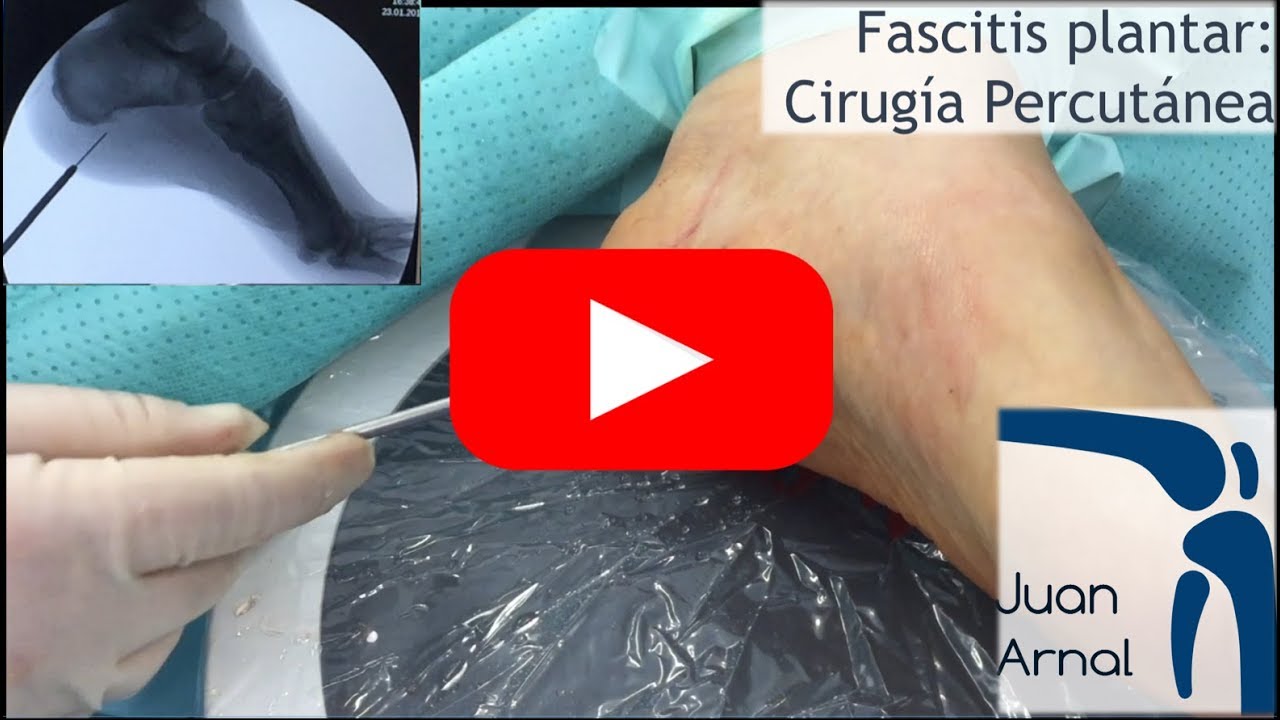 riesgos de la operacion de fascitis plantar