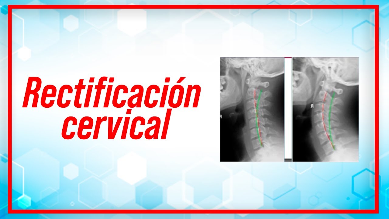 sintomas de la rectificacion de la lordosis cervical
