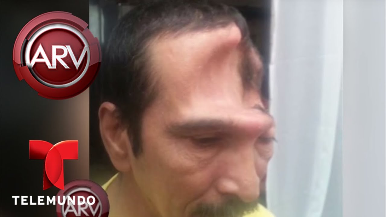 tengo un hueco en el cráneo