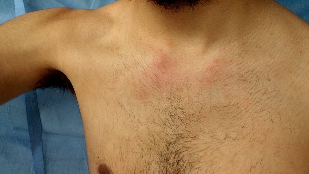 tengo una clavicula mas salida que otra