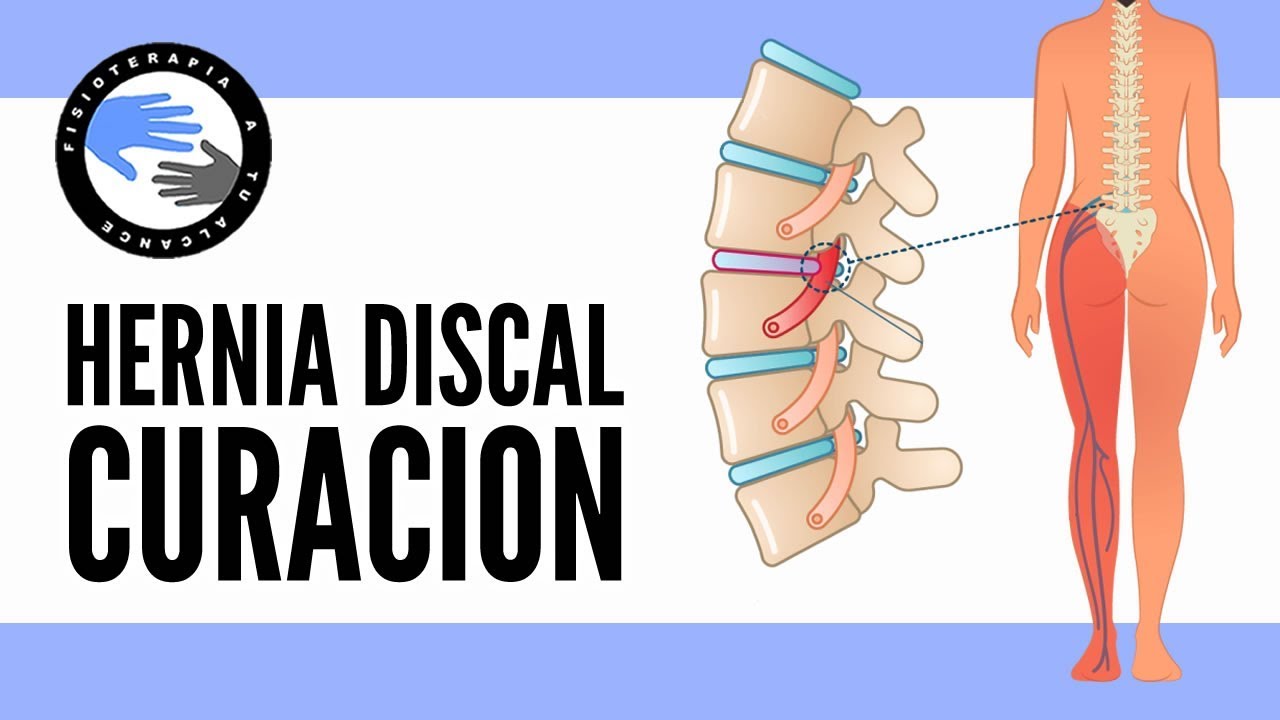 tiempo de baja por protusión discal