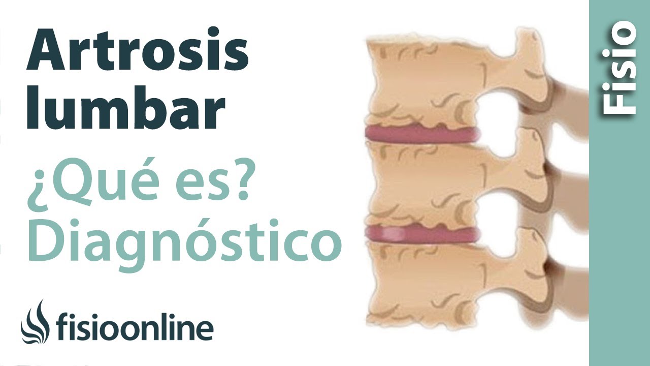 artrosis en la columna vertebral consecuencias