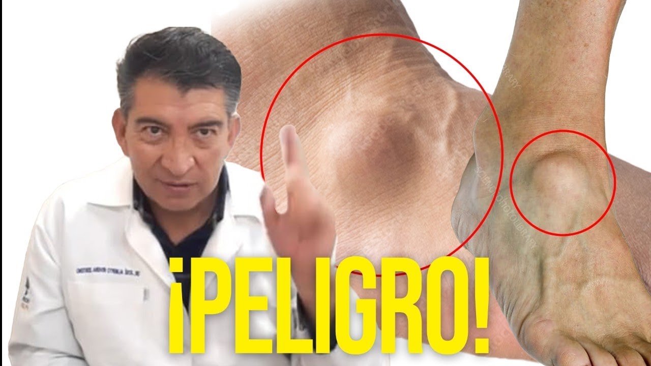 bulto duro en el empeine del pie