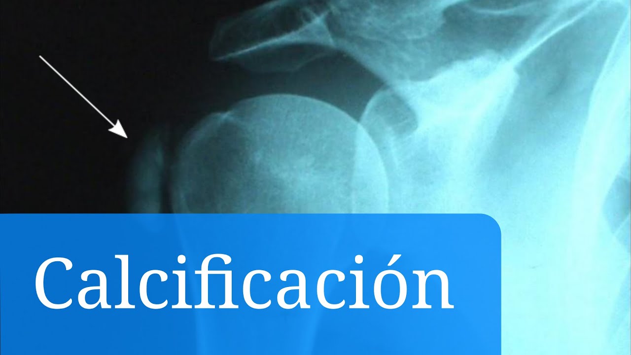 calcificaciones en la prostata tratamiento natural