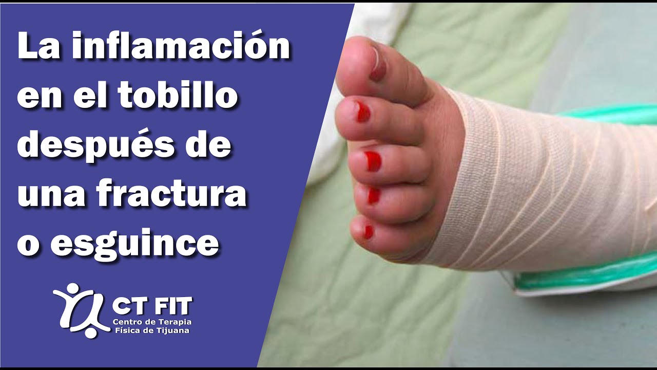 como bajar la hinchazon despues de una fractura