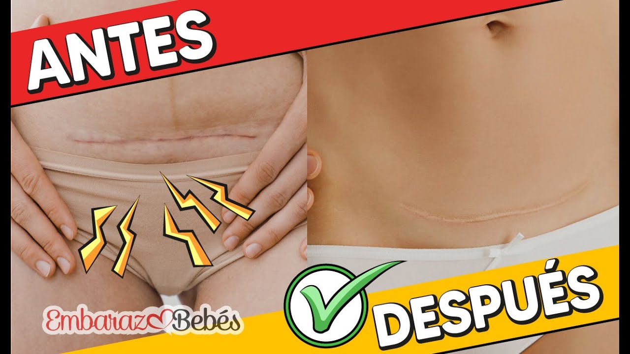 como cuidar la cicatriz de una cesarea