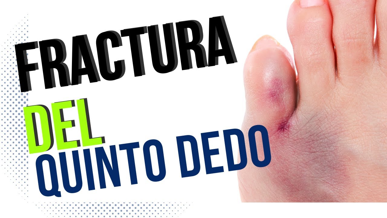 como curar un golpe en el dedo meñique del pie