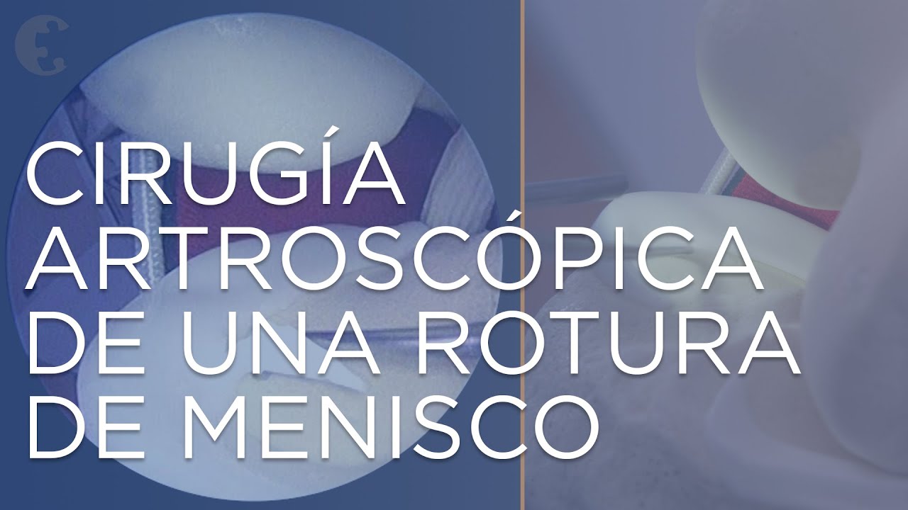 como se llama la operacion de meniscos
