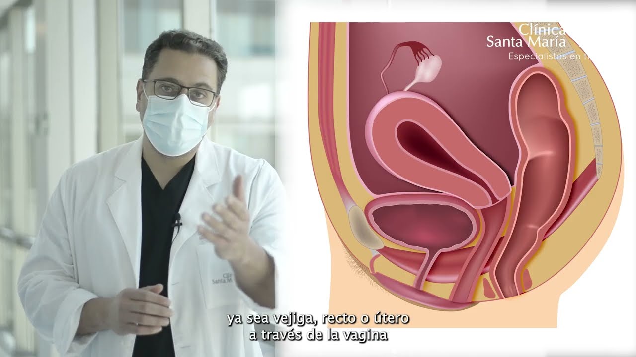 como se si tengo prolapso uterino