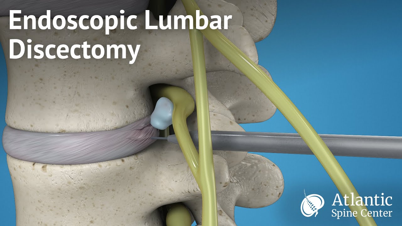 discectomia lumbar l 4 l 5