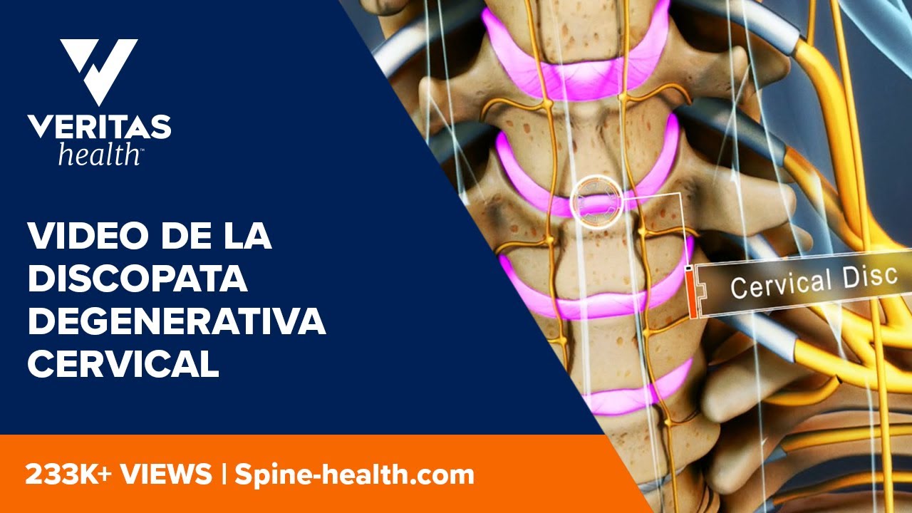discopatia degenerativa cervical c5 c6 c7