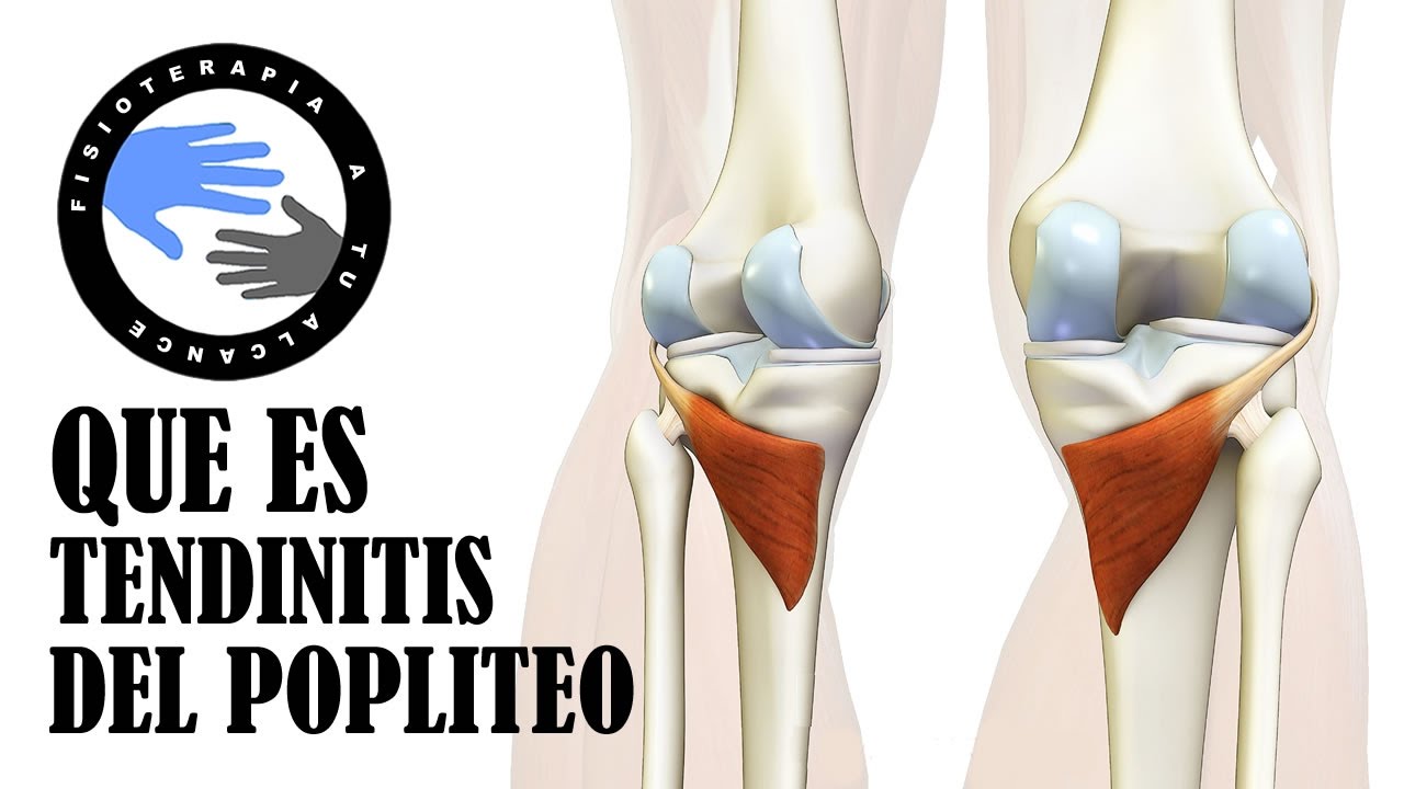 dolor en el hueco popliteo al flexionar