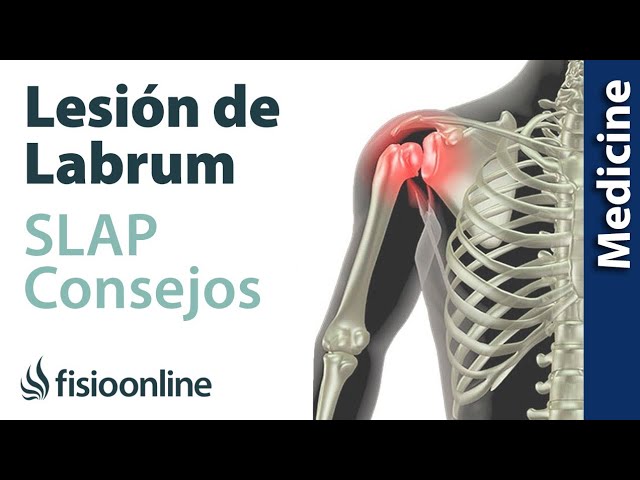 esguince de hombro tiempo de baja
