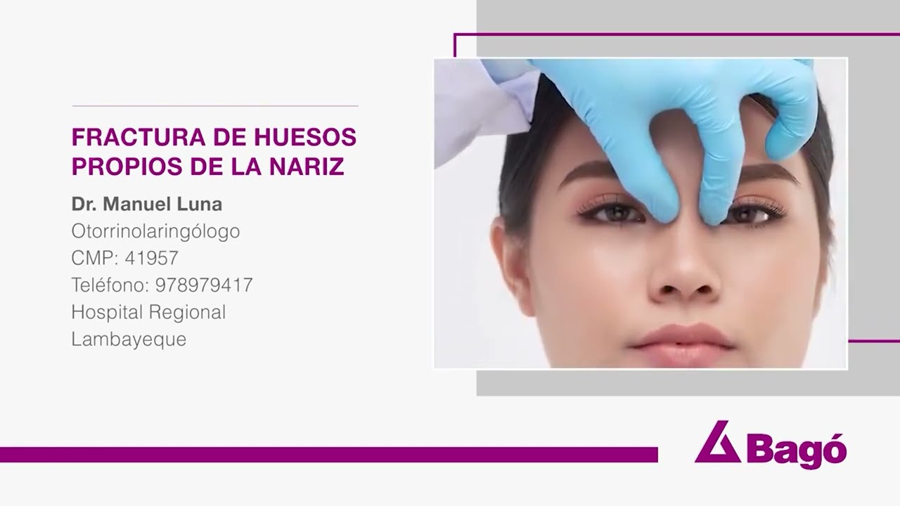 fractura de huesos propios de la nariz