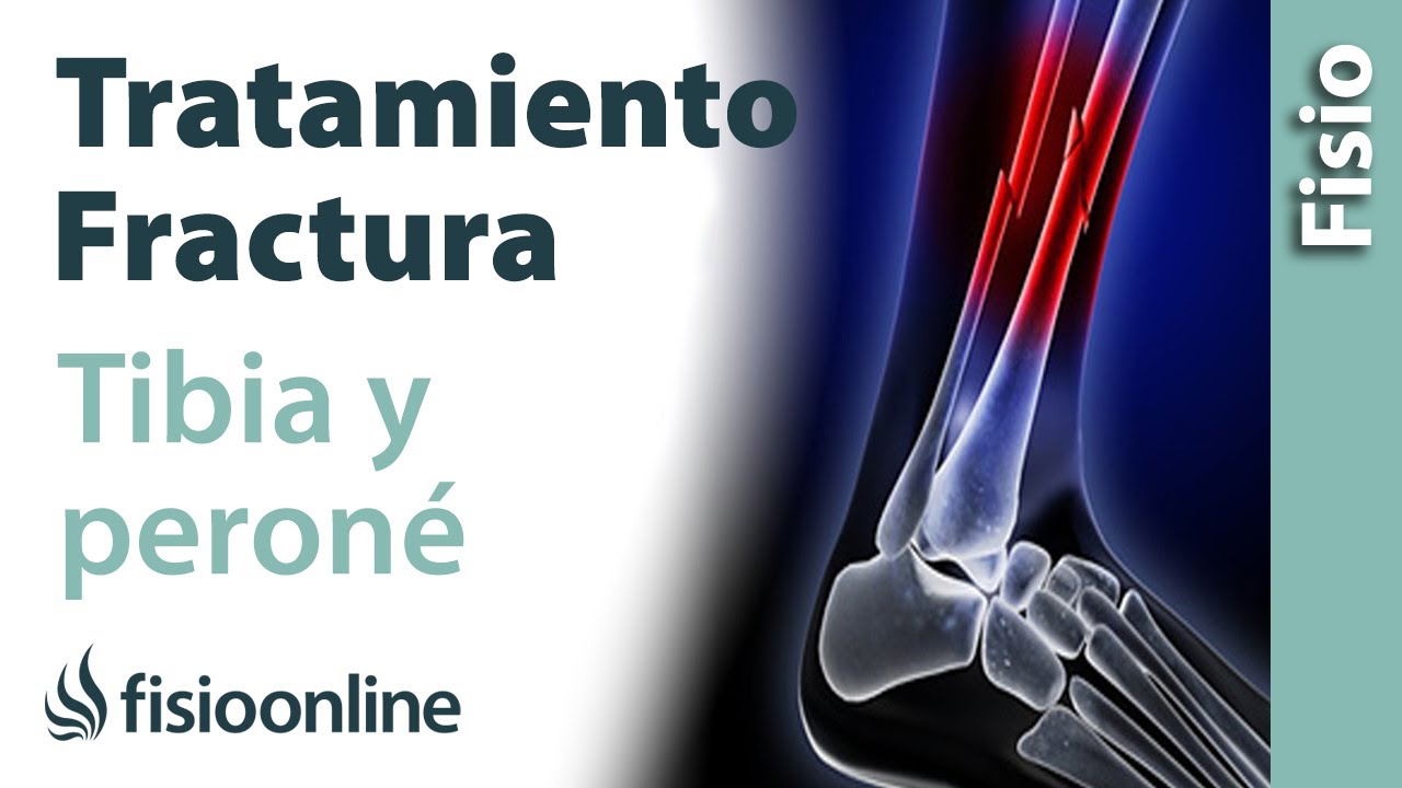 fractura de tibia y perone que es