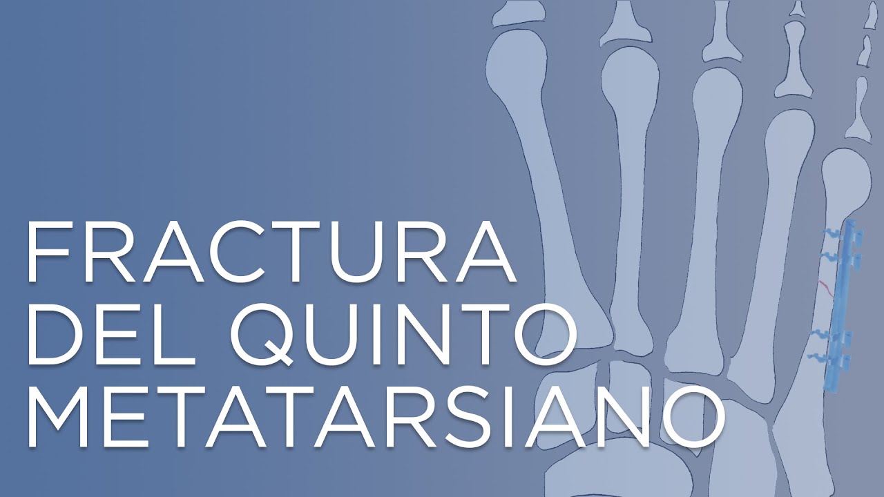 fractura quinto metatarsiano pie tiempo de recuperacion