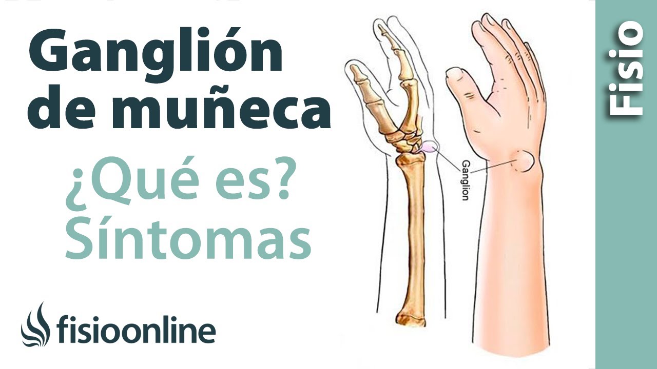 hernia en la muñeca dela mano