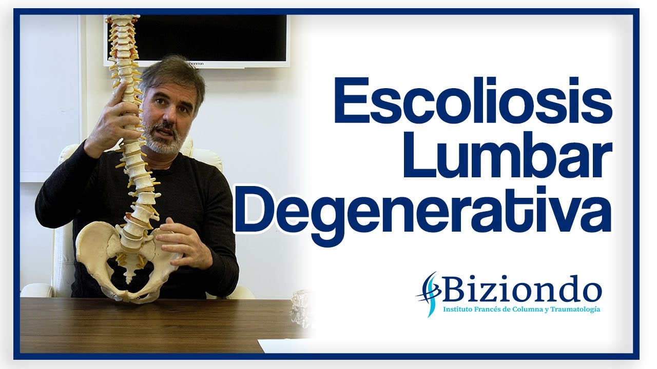 leve escoliosis lumbar de concavidad derecha