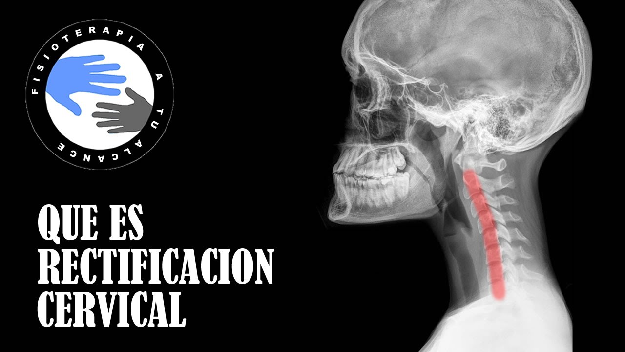 leve rectificacion de la lordosis cervical