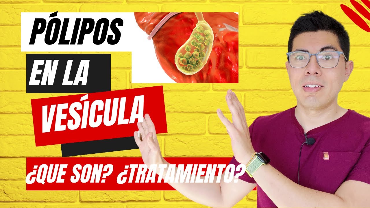 porque se producen los polipos en la vesicula