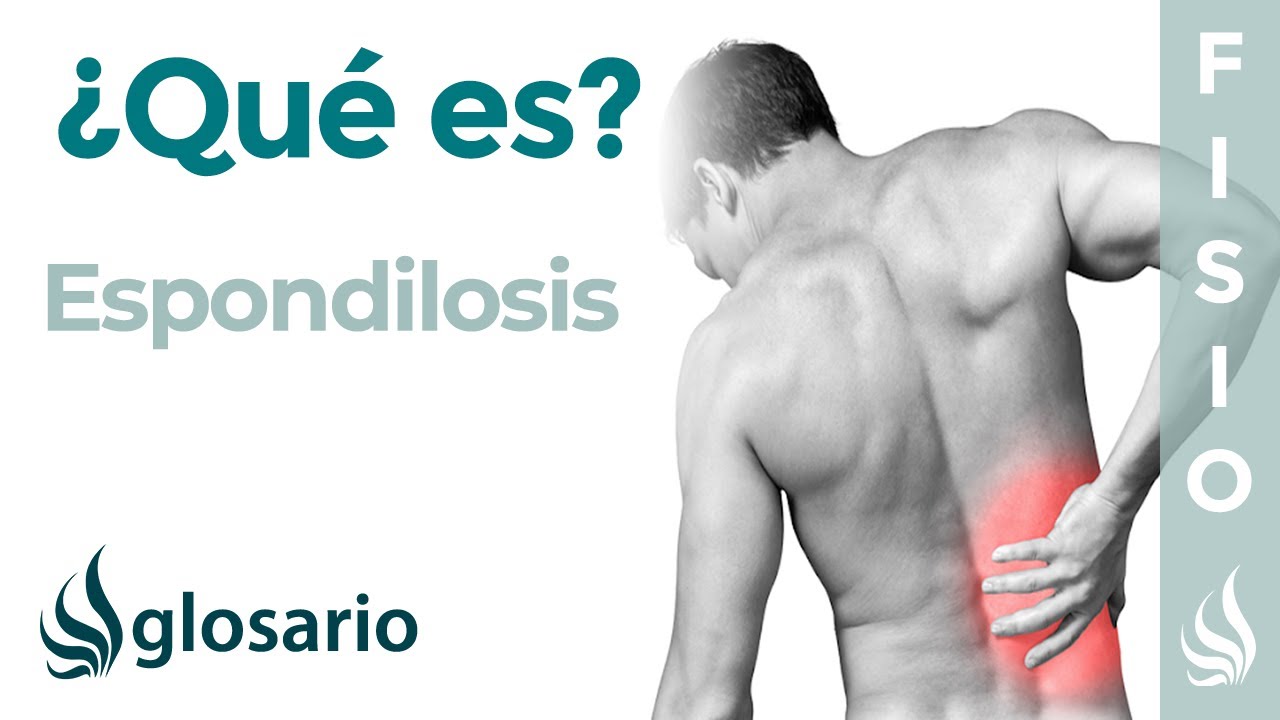 qué es espondilosis de la columna dorsal