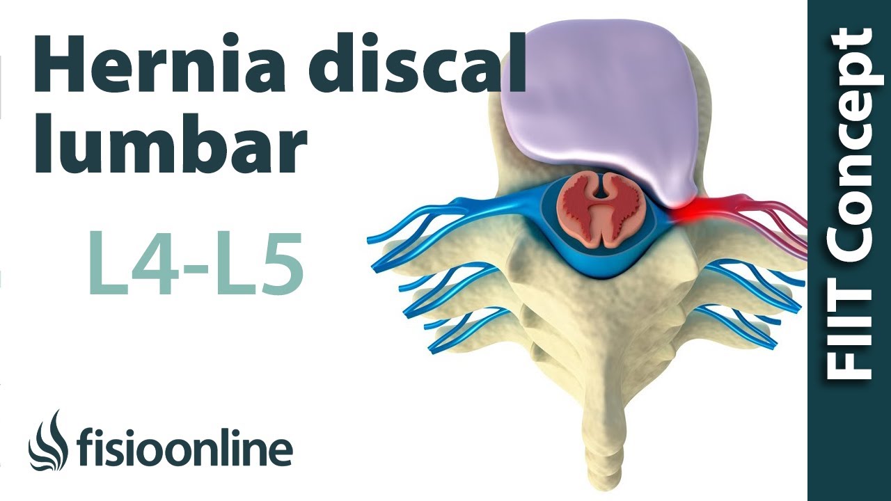 qué es una discopatia lumbar l4 l5