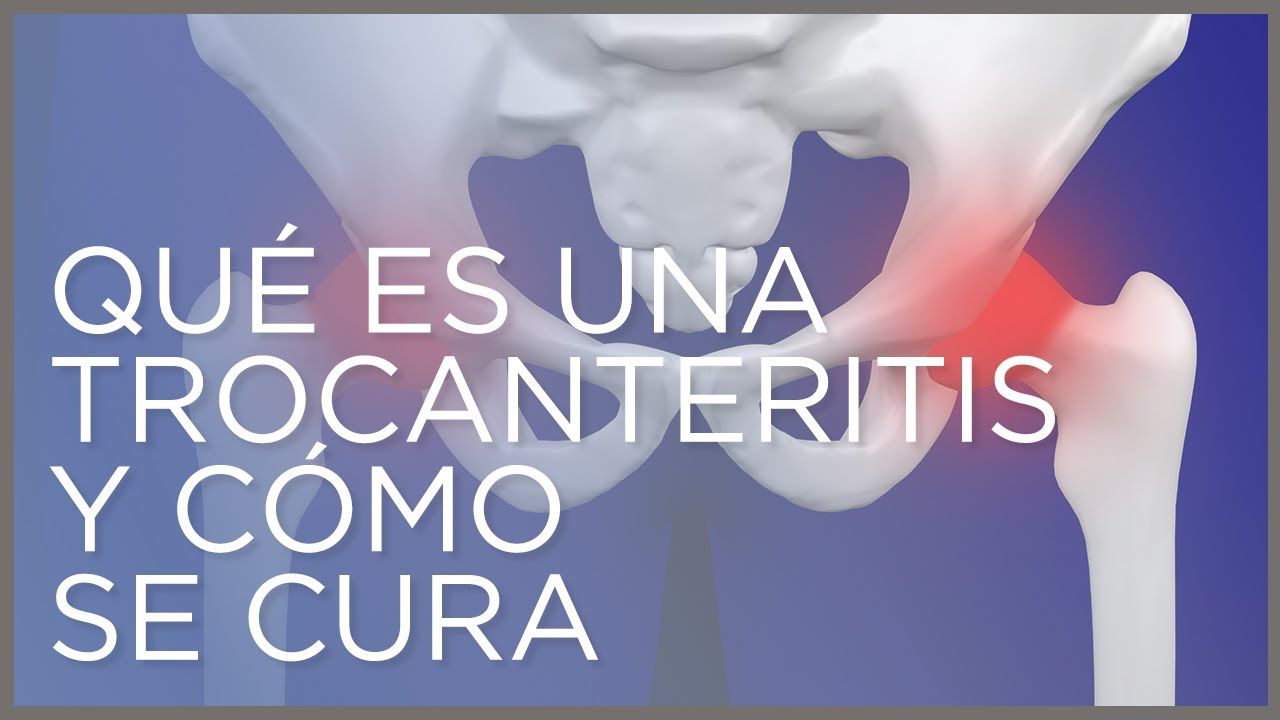 qué es una trocanteritis en la cadera