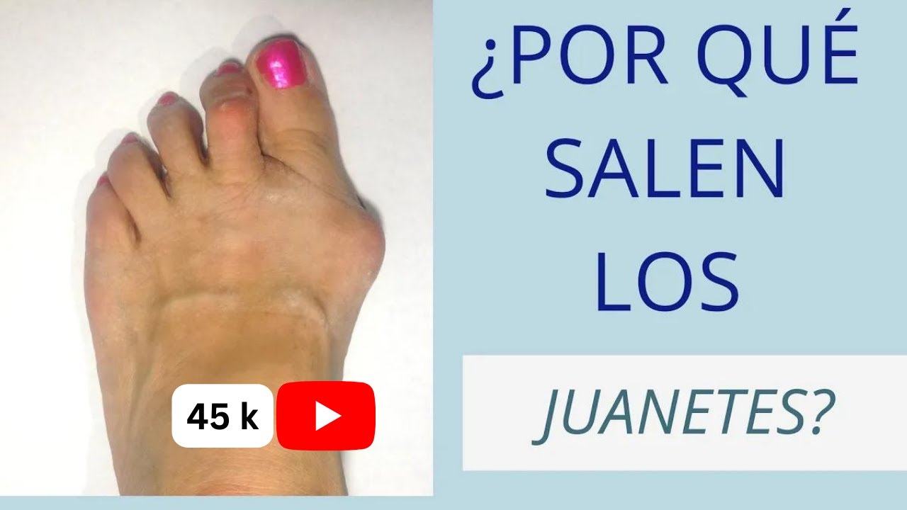 que especialista medico trata los juanetes