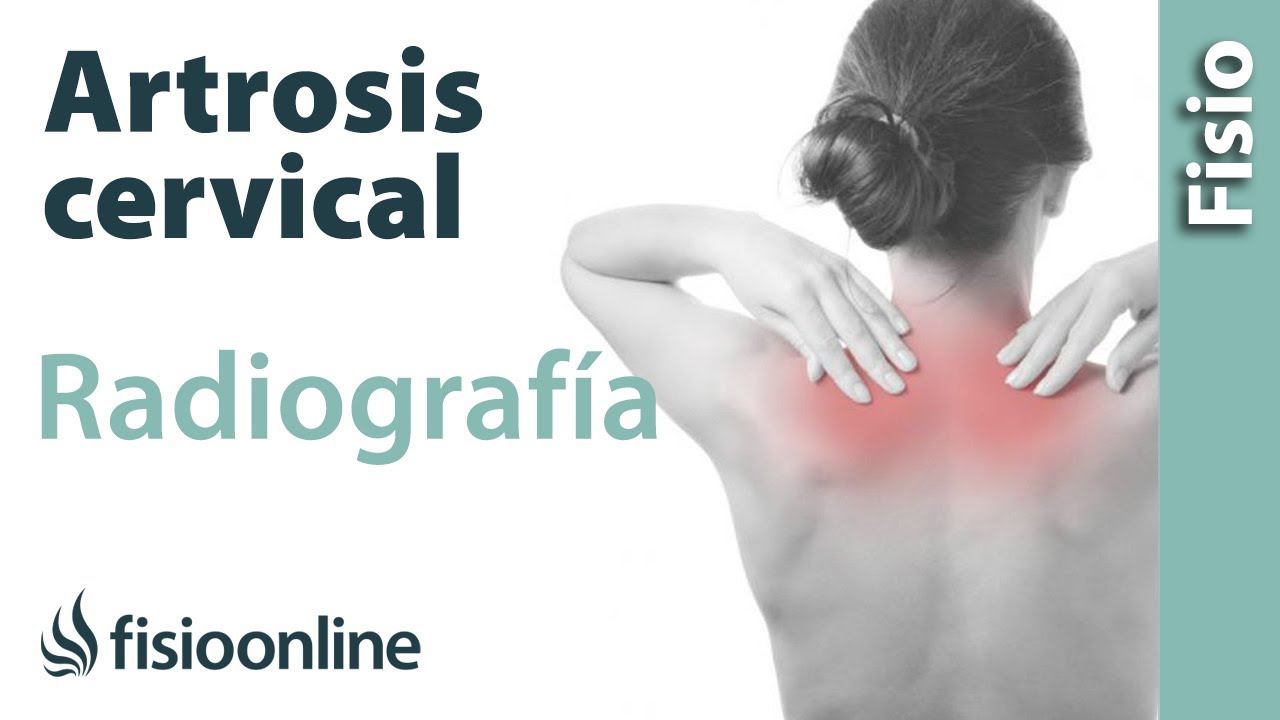 que tomar para la artrosis cervical