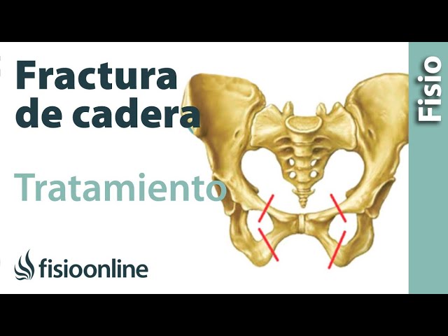 reposo en un fractura de fémur