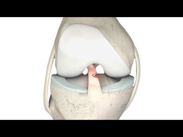ruptura parcial del ligamento cruzado anterior