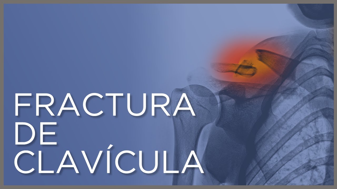 se puede conducir con la clavicula rota